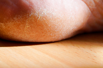 Fototapeta premium Closeup image of a heel on the foot with a white callus.