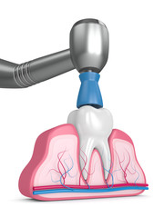 3d render of tooth with dental handpiece and polishing prophy cup