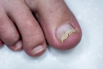 Onycholysis isolated on white background. Mechanical damage to the nail plate. Damage to the nail...