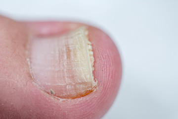 Onycholysis isolated on white background. Mechanical damage to the nail plate. Damage to the nail after applying shellac or gel-varnish (Gel-lacquer).