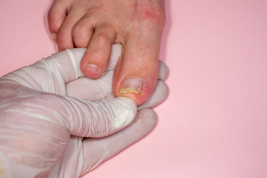 OnychomadesisBilder StockFotos & Videos. Adobe Stock