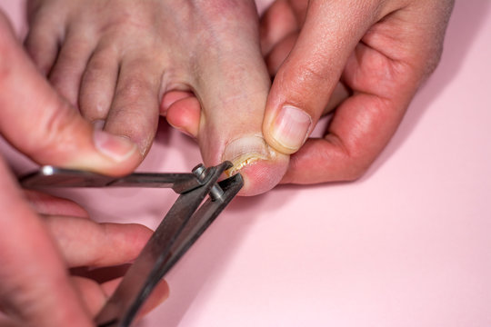 Onychomadesis Bilder Durchsuchen 147 Archivfotos, und