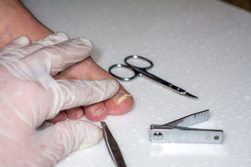 Onycholysis isolated on white background. The hands of the doctor in gloves. Mechanical damage to the nail plate. Damage to the nail after applying shellac or gel-varnish (Gel-lacquer).