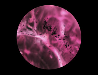 cancer cells under a microscope. Tissues affected by cancer cells under the microscope, Science....