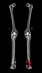 X-ray of Human Leg bone posterior view red highlights in arthritis leg Ankle pain area- 3D Medical and Biomedical illustration- Healthcare- Human Anatomy and Medical Concept- Black and white color