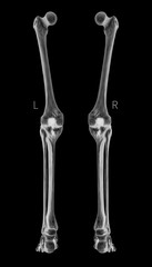 X-ray of Human Leg bone left and right- Posterior view -3D Medical and Biomedical illustration- Healthcare- Human Anatomy and Medical Concept- Black and white color.