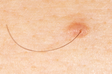 Birthmark on human skin.