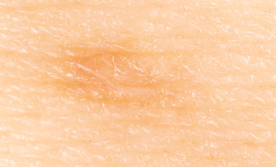 Birthmark on human skin.