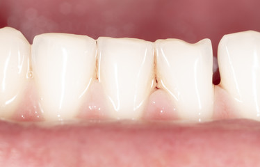 Teeth in a man's mouth