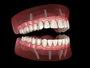 Maxillary and Mandibular prosthesis with gum All on 4 system supported by implants. Medically...