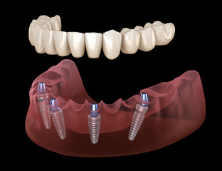 Mandibular prosthesis All on 4 system supported by implants. Medically accurate 3D illustration of...