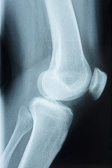 Detail of the x-ray of the bones of the human knee