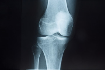 Detail of the x-ray of the bones of the human knee