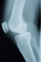Detail of the x-ray of the bones of the human knee