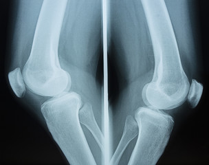 Detail of the x-ray of the bones of the human knee