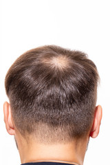 Obraz premium Hair loss concept. Young man with bald head, hair loss - Image 