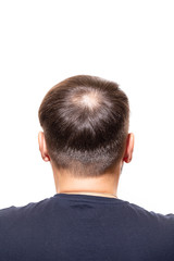 Obraz premium Hair loss concept. Young man with bald head, hair loss - Image 
