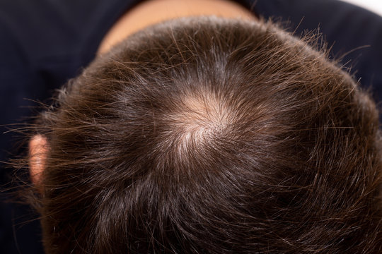 Hair loss concept. Young man with bald head, hair loss - Image  