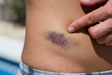 Detail of big bruise on man body