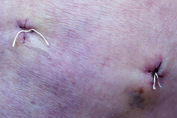 stitches in knee scar by arthroscopy operation at meniscal tear