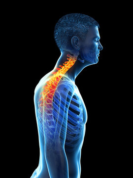 3d rendered medically accurate illustration of a mans painful neck
