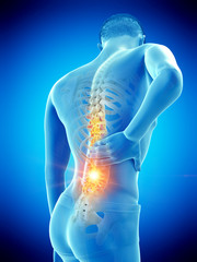 3d rendered medically accurate illustration of a mans painful back