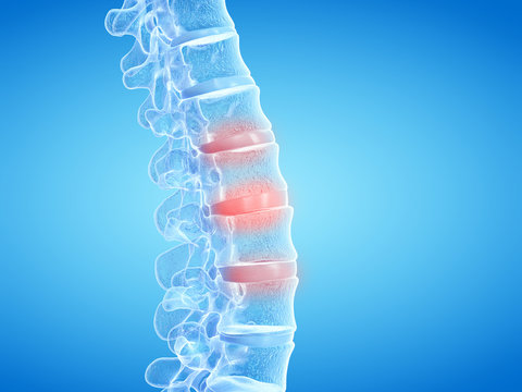 3d Rendered Medically Accurate Illustration Of Painful Intervertebral Discs