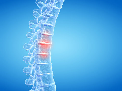 3d rendered medically accurate illustration of painful intervertebral discs