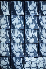 R.M.N. Nuclear magnetic resonance, of human knees, with cross-section and sagittal section.