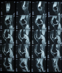 R.M.N. Nuclear magnetic resonance, of human knees, with cross-section and sagittal section.