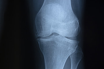 Detail of the x-ray of the bones of the human knee