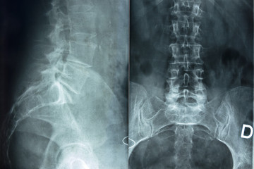 X-ray of pelvic bones and human spine.