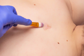 Doctor cosmetologist applies a chemical peeling to the patient for a scar and a scar on the back...
