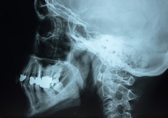 Radiography, in profile of the human skull.
