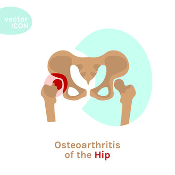 Hip Osteoarthritis Icon