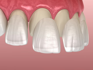 Veneer installation procedure over central incisor and lateral incisor. Medically accurate tooth 3D illustration