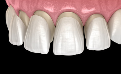 Veneer installation procedure over central incisor and lateral incisor. Medically accurate tooth 3D illustration