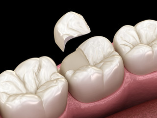 Onlay ceramic crown fixation over tooth. Medically accurate 3D illustration of human teeth treatment