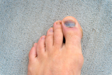 Injury of toe nail. Effects wearing uncomfortable footwear. Nail hematoma. Take care of your feet....
