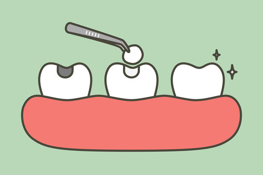 step of tooth amalgam filling by dental tools to protection decay tooth, before and after - teeth cartoon vector flat style