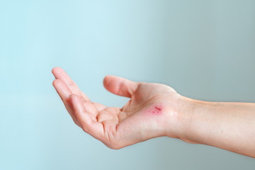 scratch wound on female hand closeup, healthcare and medicine concept