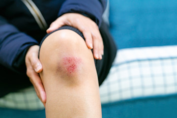 scratch wound on female knee closeup, healthcare and medicine concept