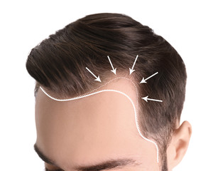 Young man with hair loss problem on white background, closeup - obrazy, fototapety, plakaty