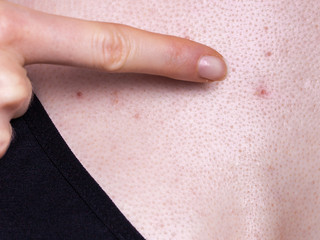 Woman having pimples red spots on chest