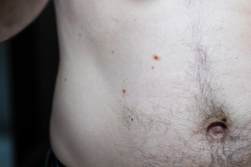 Naklejka premium Melanocytic nevus, some of them dyplastic or atypical, on a caucasian man of 36 years old
