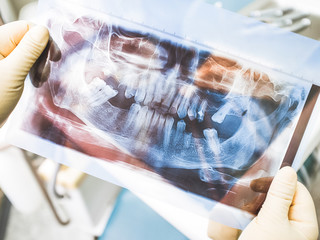 Dental implant therapy. Surgeon studying agomphiasis example on panoramic x ray. Human jaw, plenty of lost teeth.