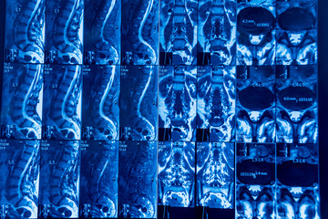 MRI scan of spine a patient with chronic back pain.