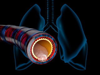 Bronchitis anatomy, mucus secreted as a chest cold as a 3D illustration - obrazy, fototapety, plakaty