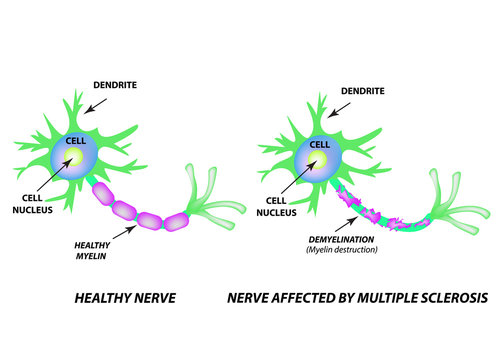 The destruction of the myelin sheath on the axon. Damaged myelin. Neuron affected by multiple sclerosis. World Multiple Sclerosis Day. Infographics. Vector illustration on isolated background.