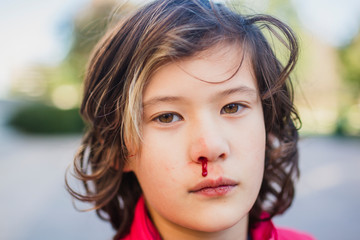 A boy looks directly at the camera with a nosebleed